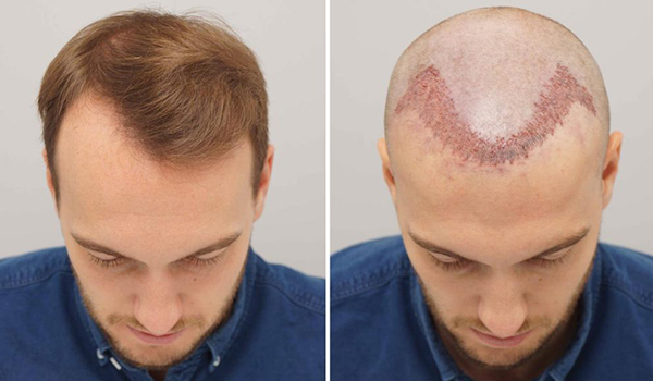 Hair Transplantation